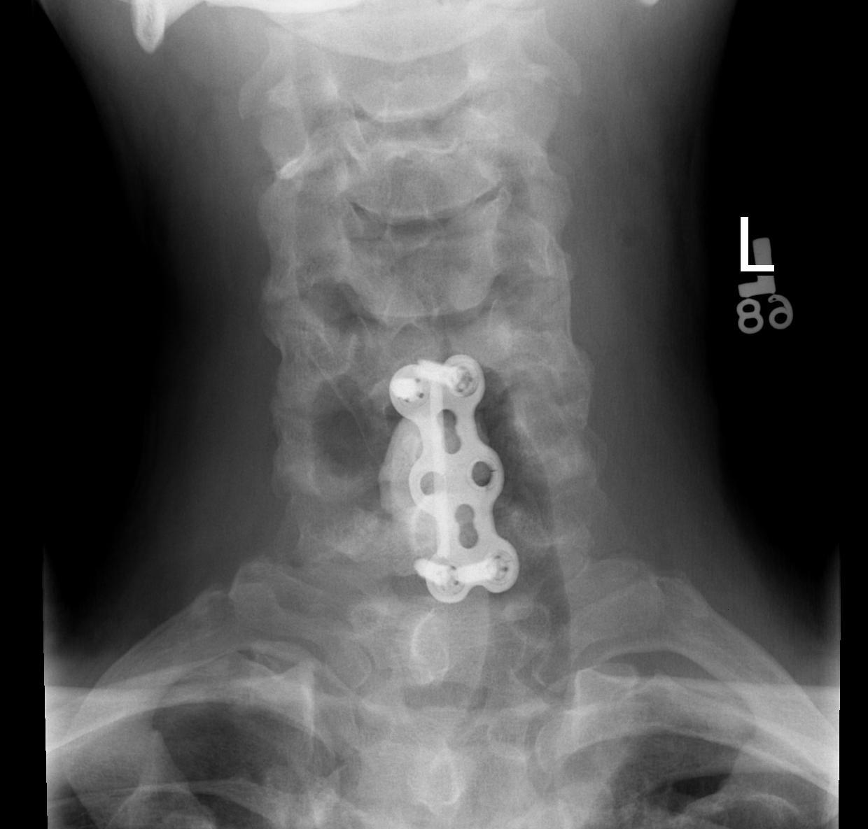 Cervical Spine Anterior Stabilisation 2